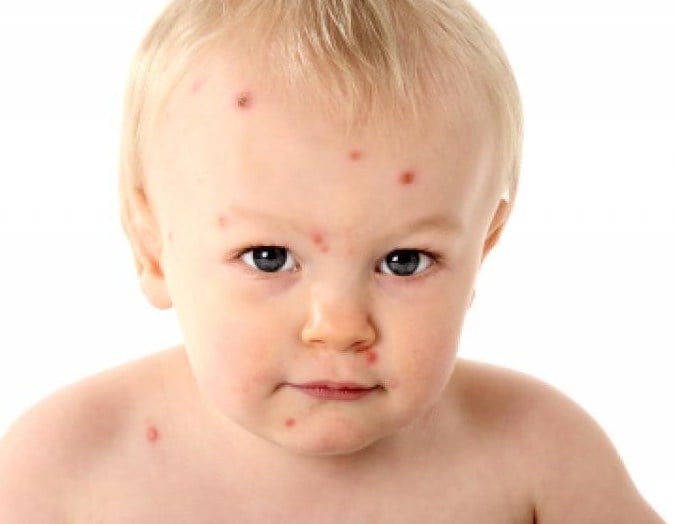 Аллергия у ребенка на грудном вскармливании