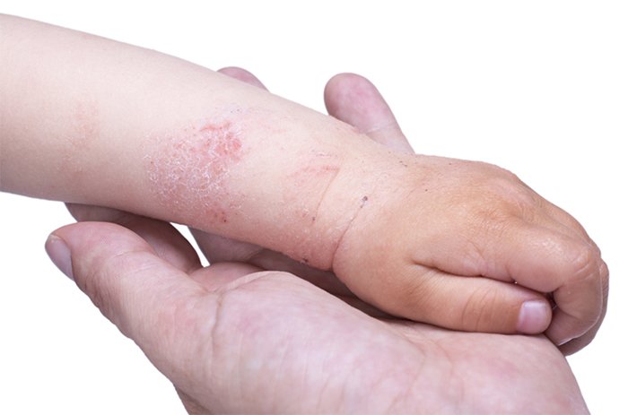 пищевая аллергия у младенца