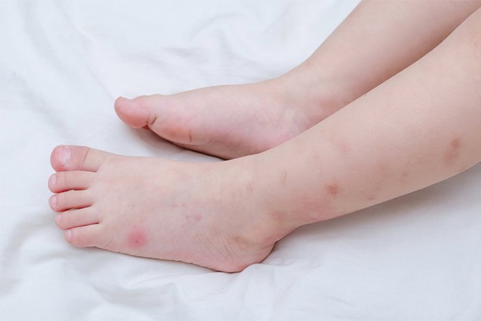 аллергия на укус насекомых у ребенка