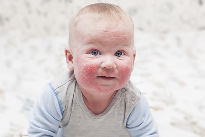 аллергия у малыша 
