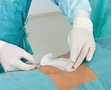 врач накладывает пластырь на живот после операции