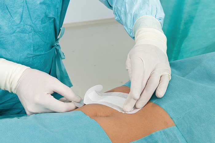 врач накладывает пластырь на живот после операции 