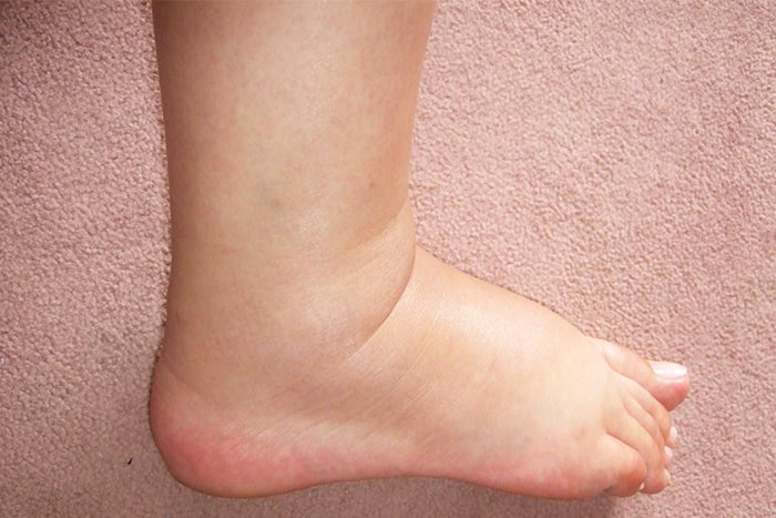 аллергический отек ног у ребенка 