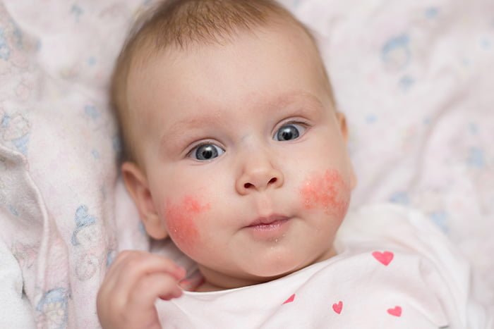 аллергия на коже у ребенка 