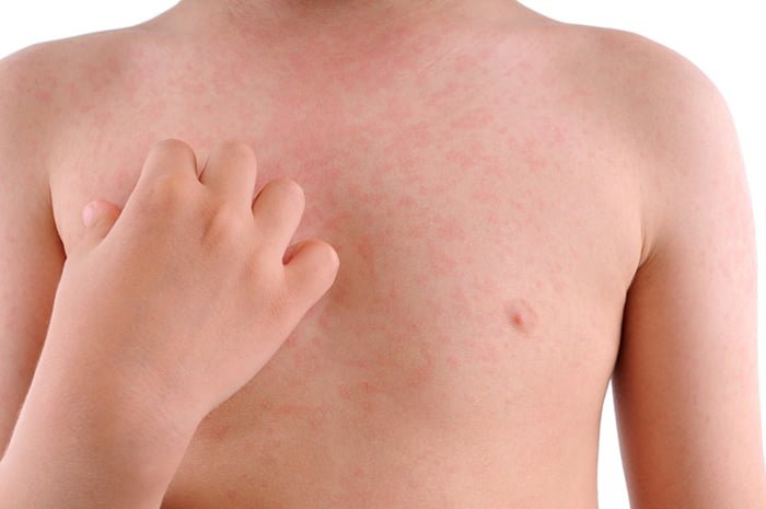 аллергия на теле ребенка 