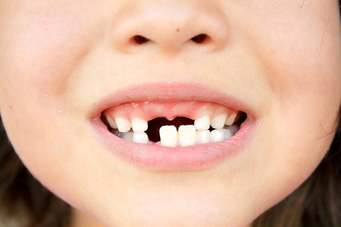 Что делать если шатается зуб у ребенка